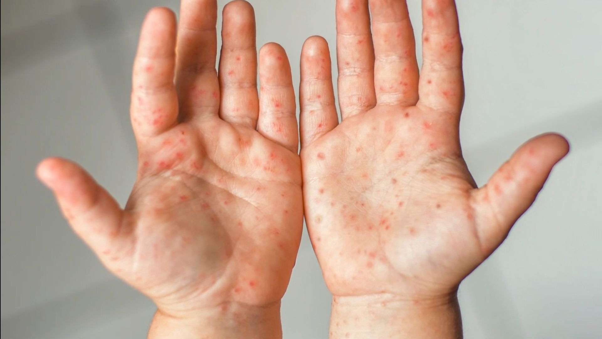 Gejala Flu Singapura pada Anak