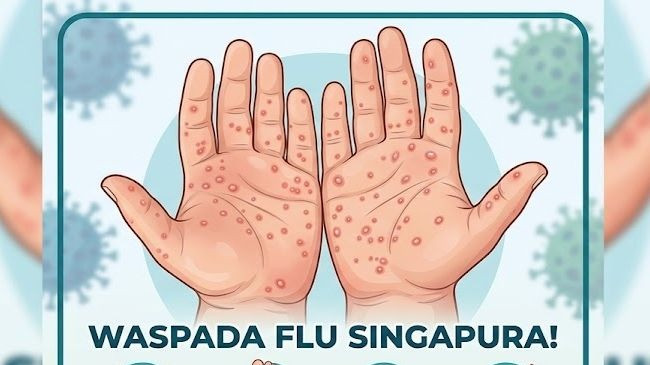 Flu Singapura Bisa Menyerang Orang Dewasa, Dokter: Segera Periksakan
            - galeri foto