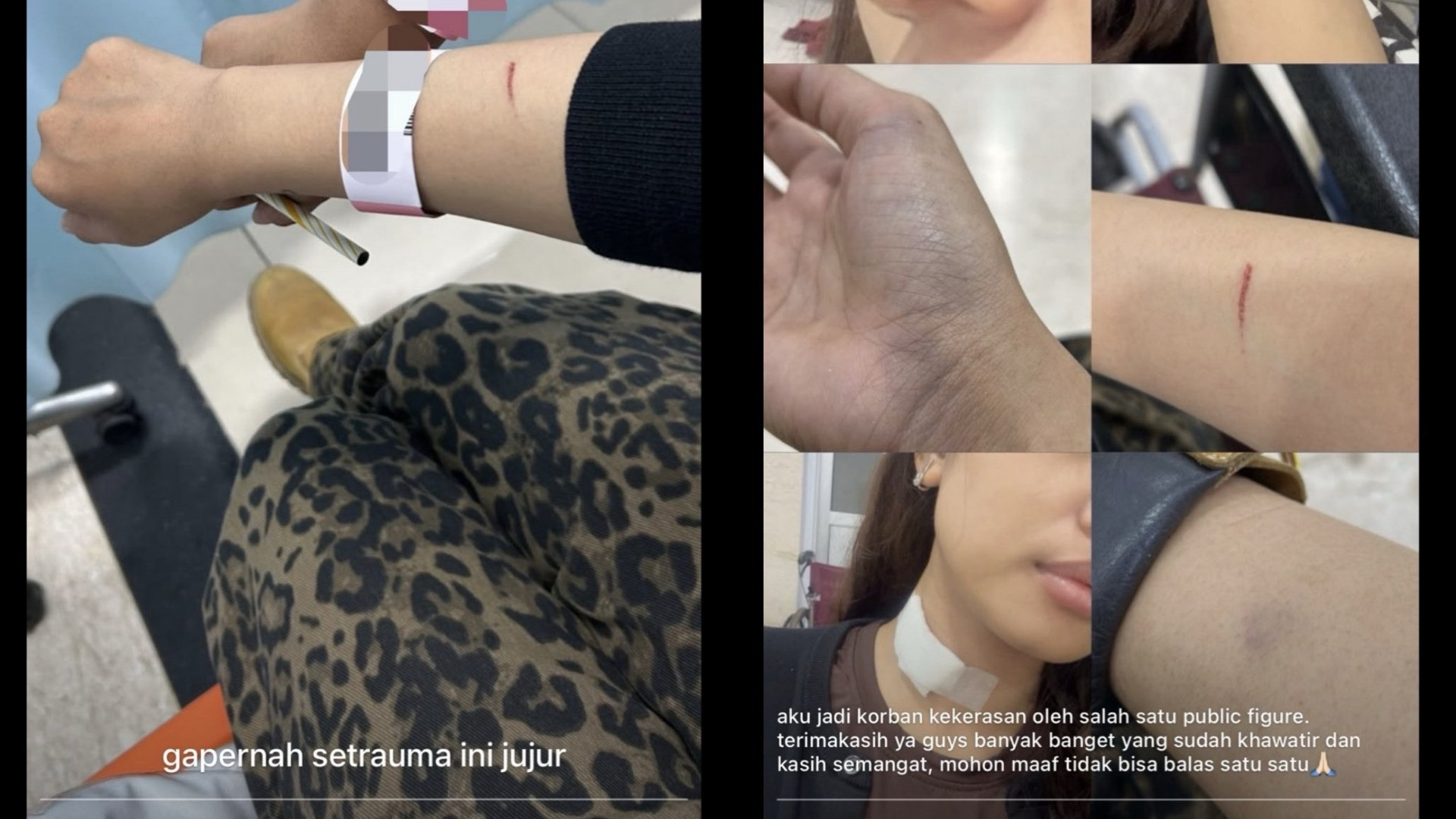 Kondisi luka korban kekerasan seksual yang diduga dilakukan oleh Betrand Peto