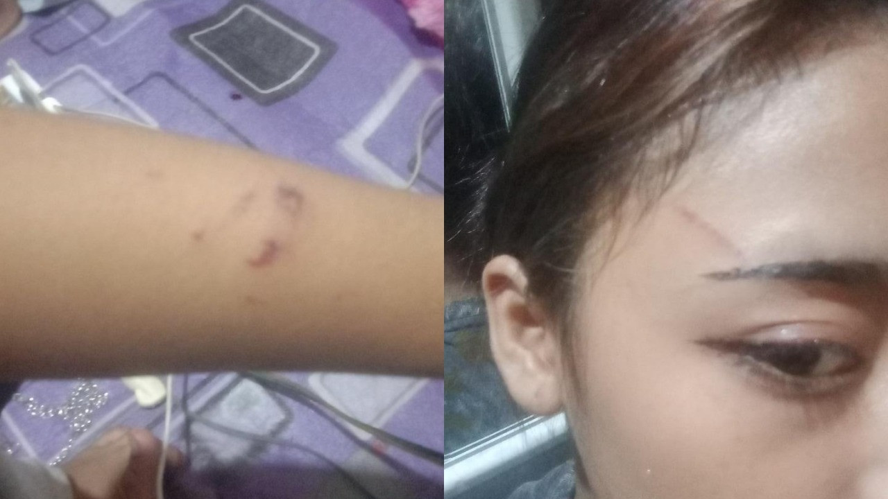 Luka di tubuh korban usai mendapat penganiayaan dalam kasus perundungan di wilayah Tambora, Jakarta Barat