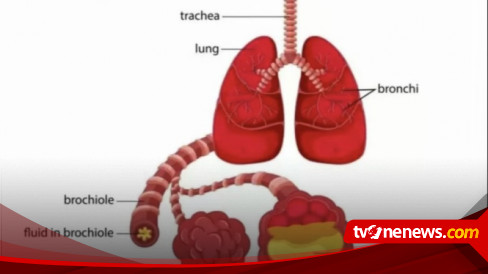 Apa Itu Pneumonia, Gejala, Penyebab Dan Cara Pengobatannya